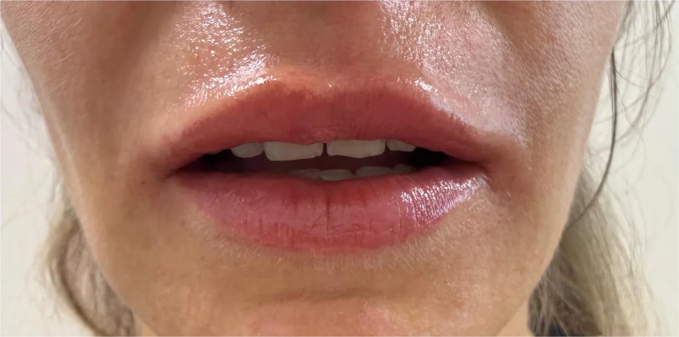 Acid hialuronic, după procedură: buze, din față