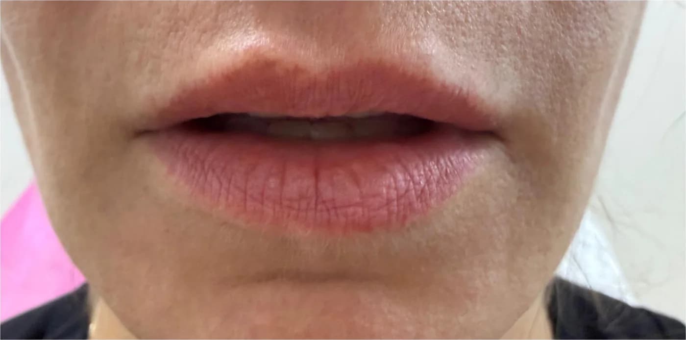 Acid hialuronic, înainte de procedură: buze, din față